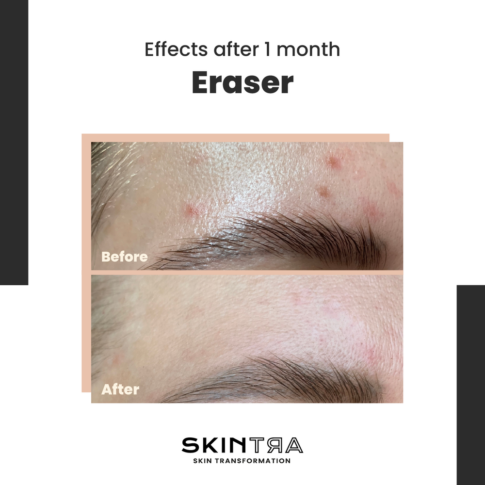 Eraser